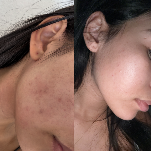 Visage taches Acné tenace