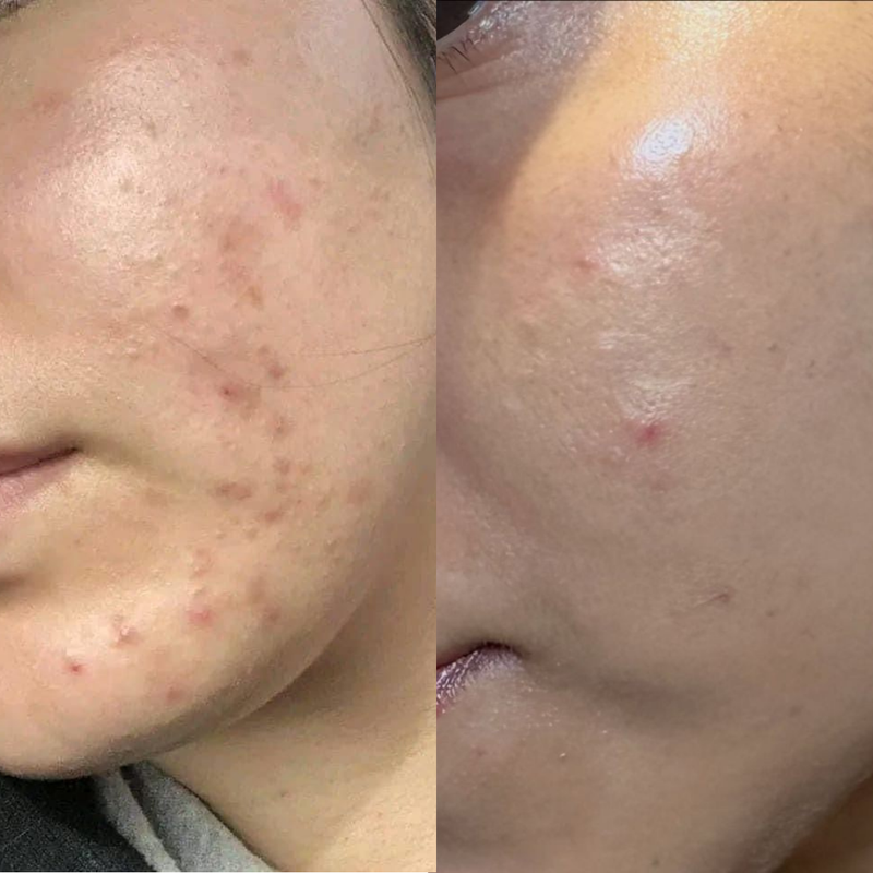 Texture de peau améliorée rapidement