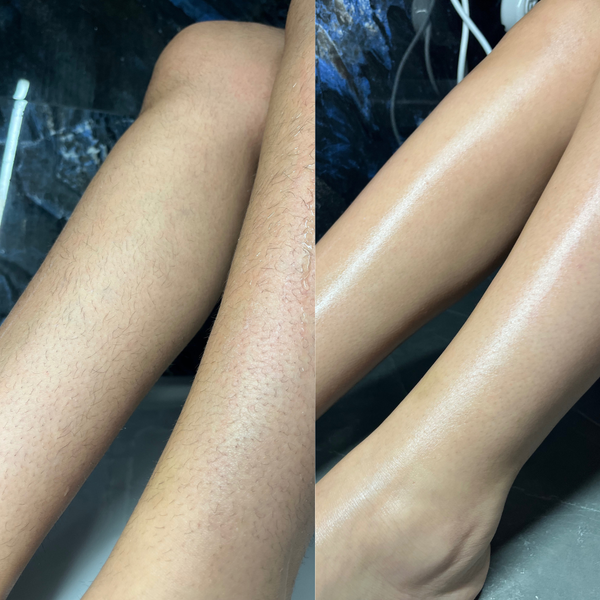 JAMBE DE FRAISE POILS INCARNÉ