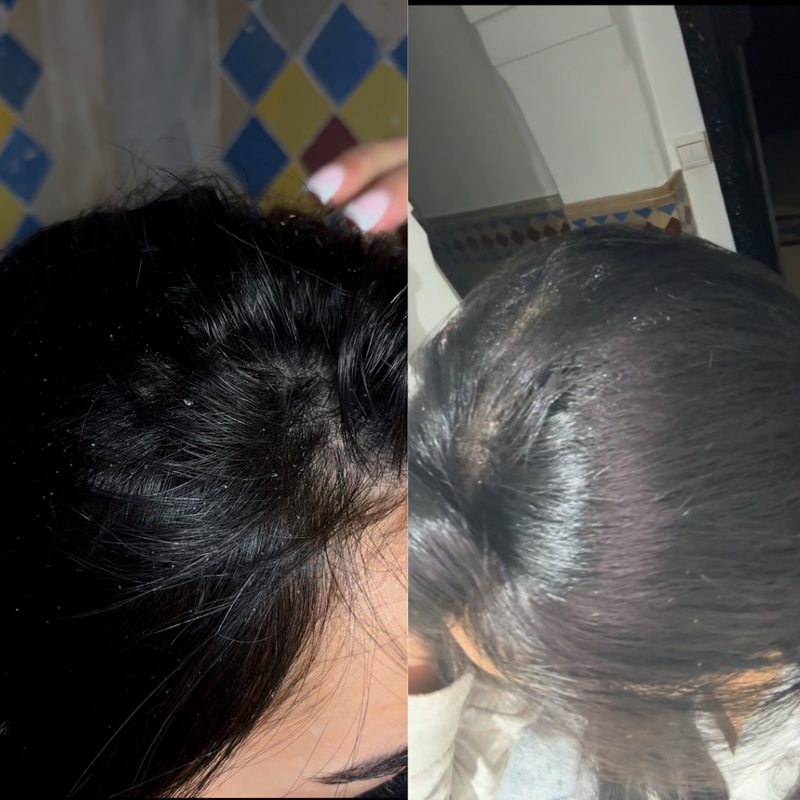 Cuir chevelu assaini, pellicules visiblement réduites